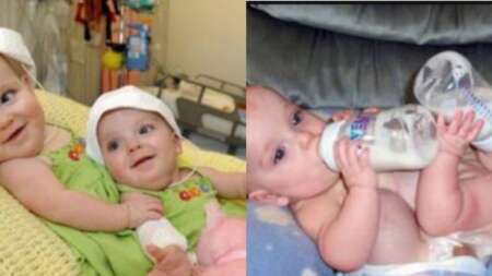 γεννήθηκαν-μαζί-χειρουργήθηκαν-24-ώρες-100569