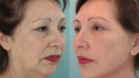 εξαφανίστε-ρυτίδες-δείξτε-20-χρόνια-νεώ-100394