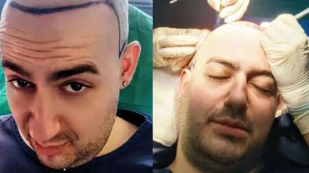 η-ανδρογενής-αλωπεκία-μου-χτύπησε-τη-105236