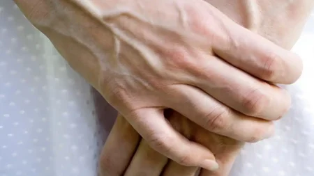 αν-δείτε-κάποιον-με-φουσκωμένες-φλέβε-224223