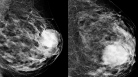 καρκίνος-του-μαστού-συμπτώματα-και-αι-222376