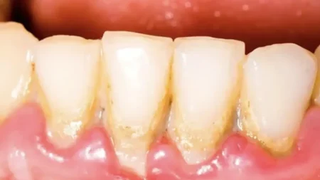 5-συμβουλές-για-να-αφαιρέσετε-εύκολα-τη-224504