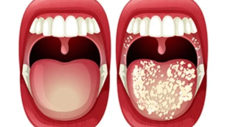 καρκίνος-στόματος-συμπτώματα-που-δεν-220855