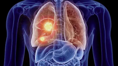 ο-καρκίνος-του-πνεύμονα-παρουσιάζει-α-222861