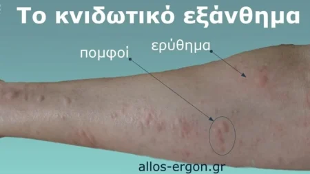 γιατί-εμφανίζονται-πομφοί-στο-δέρμα-α-227837