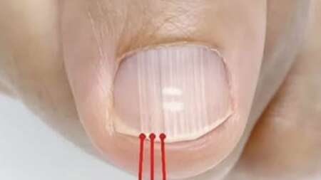 αν-έχετε-αυτές-τις-γραμμές-στα-νύχια-σα-228097