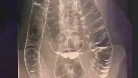 χρόνια-δυσκοιλιότητα-μια-σιωπηλή-απ-237208