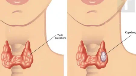 οι-περιπτώσεις-καρκίνου-του-θυρεοειδ-234513