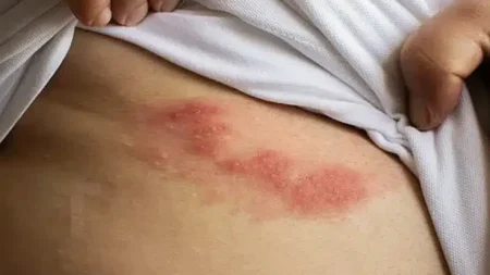 όλα-όσα-πρέπει-να-γνωρίζετε-για-τα-έρπη-233949